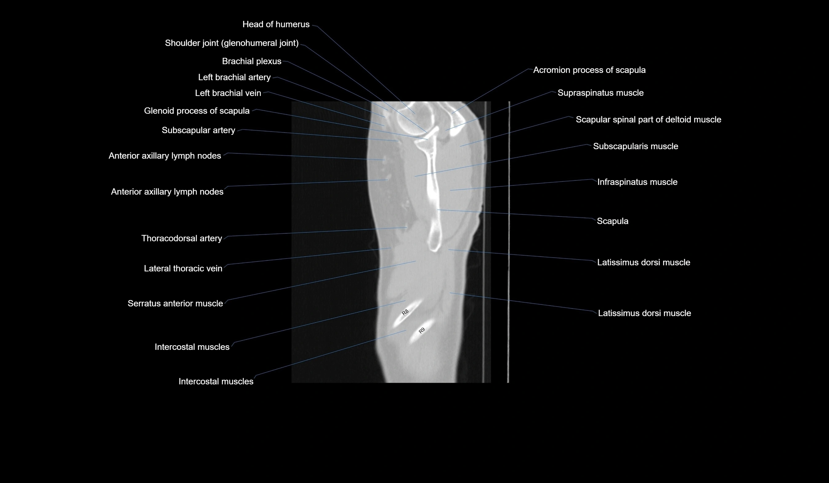 CT chest (thorax) lung window labelled sagittal cross sectional anatomy radiology image-00136.webp